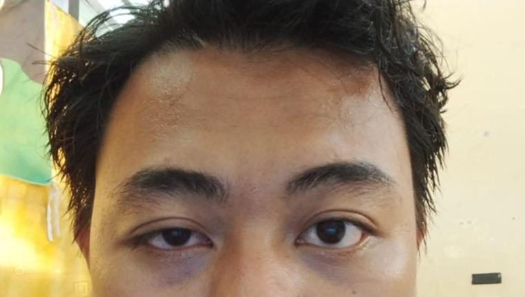 Ketua HMI FKIP Unmul Dipukul Saat Aksi Tolak Penggusuran Pasar Subuh, Mata Lebam Akibat Represi Aparat